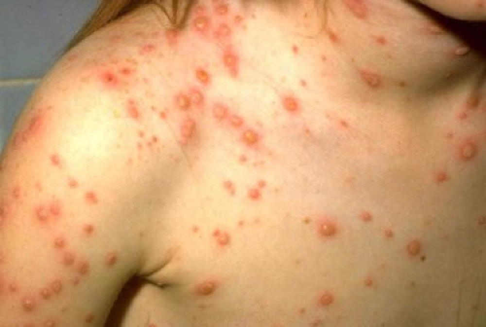 Chickenpox vs Smallpox