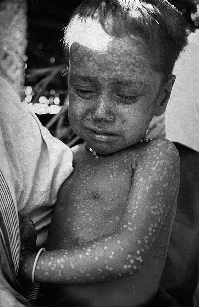 Smallpox Eradication